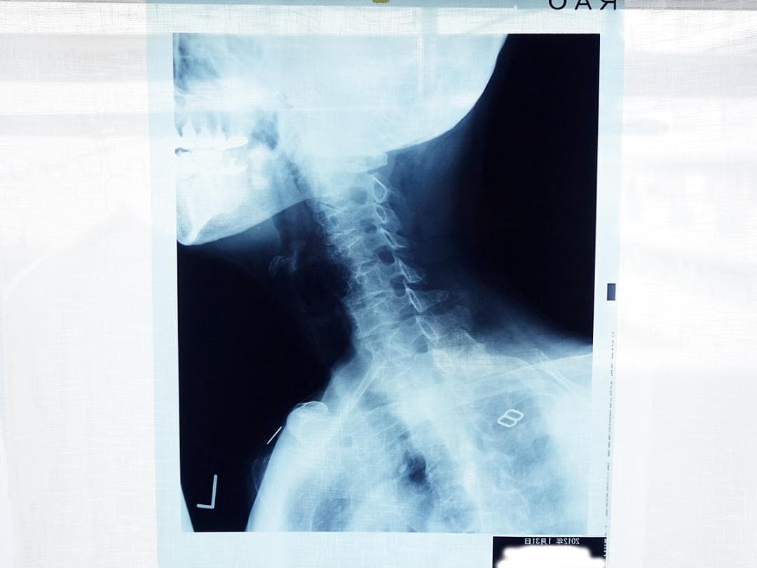 レントゲン写真　X線写真　　Z97